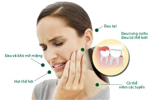 Khi răng khôn mọc, lợi tại vị trí có răng sẽ sưng lên, đôi khi có tấy đỏ và ấn đau.